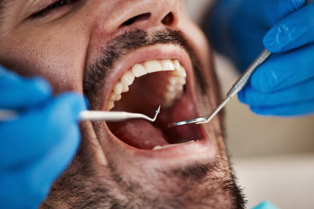 Best Emergency Treatment for Dental Infections or Abscesses in San Diego, TX