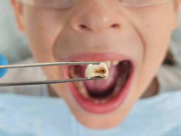 Best Emergency Treatment for Dental Infections or Abscesses in San Diego, TX